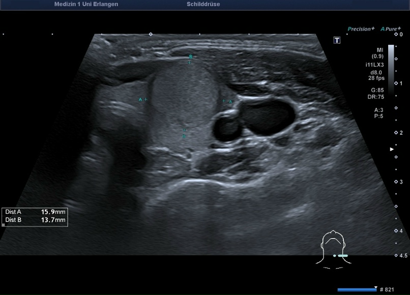Без йода. Чем болеет щитовидка?, изображение №5